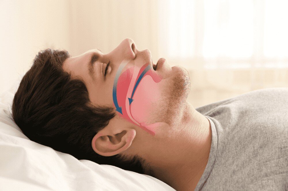 Апноэ сна: как лечить и что это такое?
