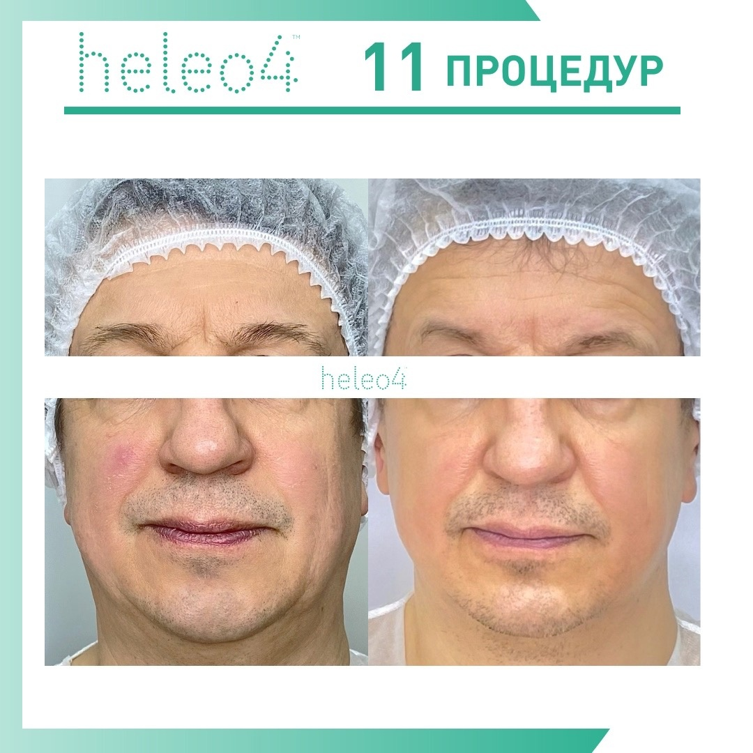 Процедура heleo4. Heleo4.