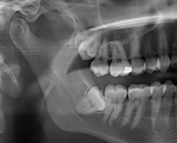Зубы мудрости прорезываются в возрасте от 17 до 27 лет. С особенностями этого процесса сталкивается практически каждый человек. «Восьмерки» ничем не отличаются от других многокорневых зубов.-4
