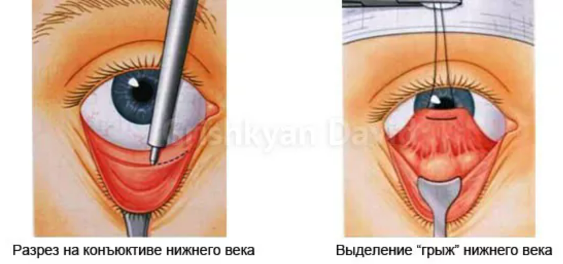 Трансконъюктивальная блефаропластика схема. Фото с сайта Д.Р. Гришкяна. Имеются противопоказания, требуется консультация специалиста