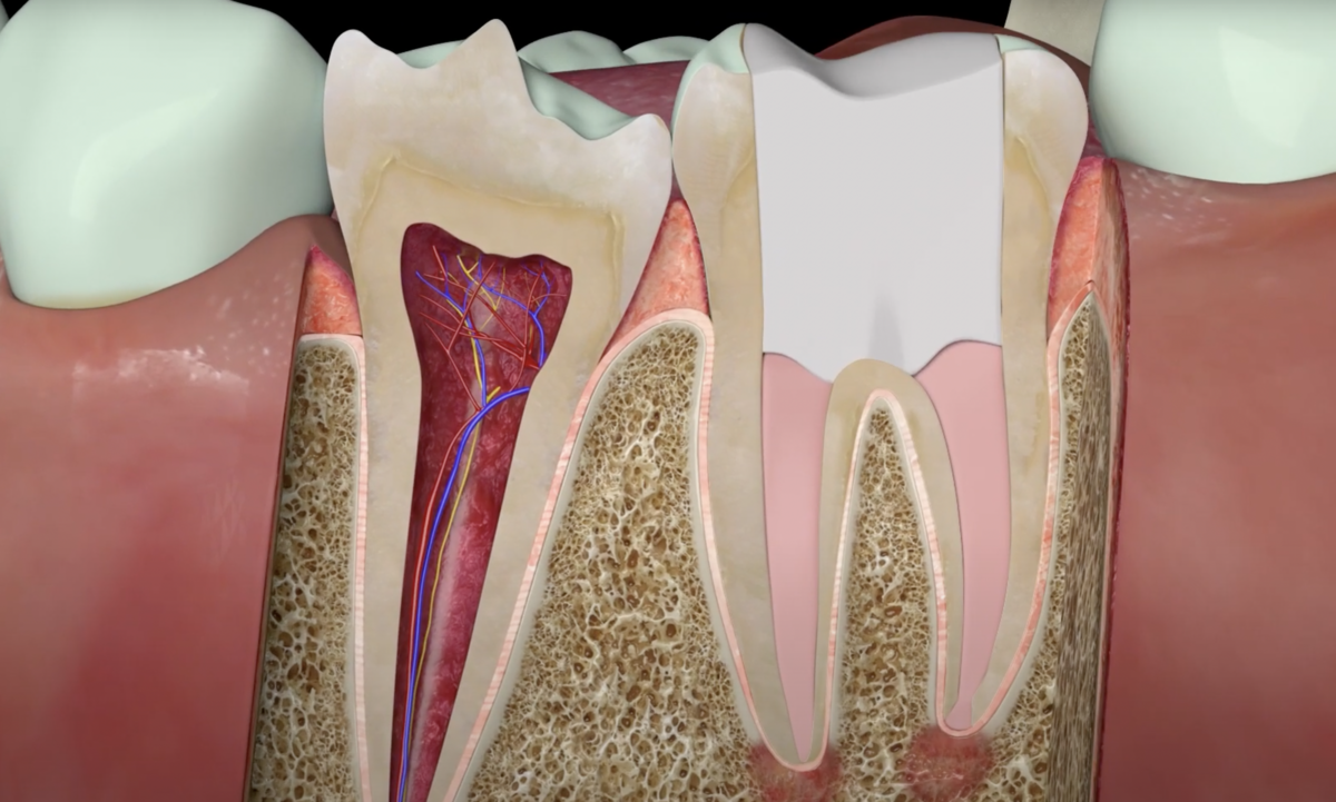 Пломбирование зуба. Фото https://implantolog-fedorov.ru/