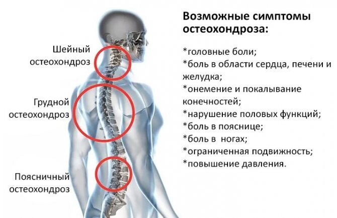 Остеохондроз позвоночника - симптомы и лечение | Семейный доктор