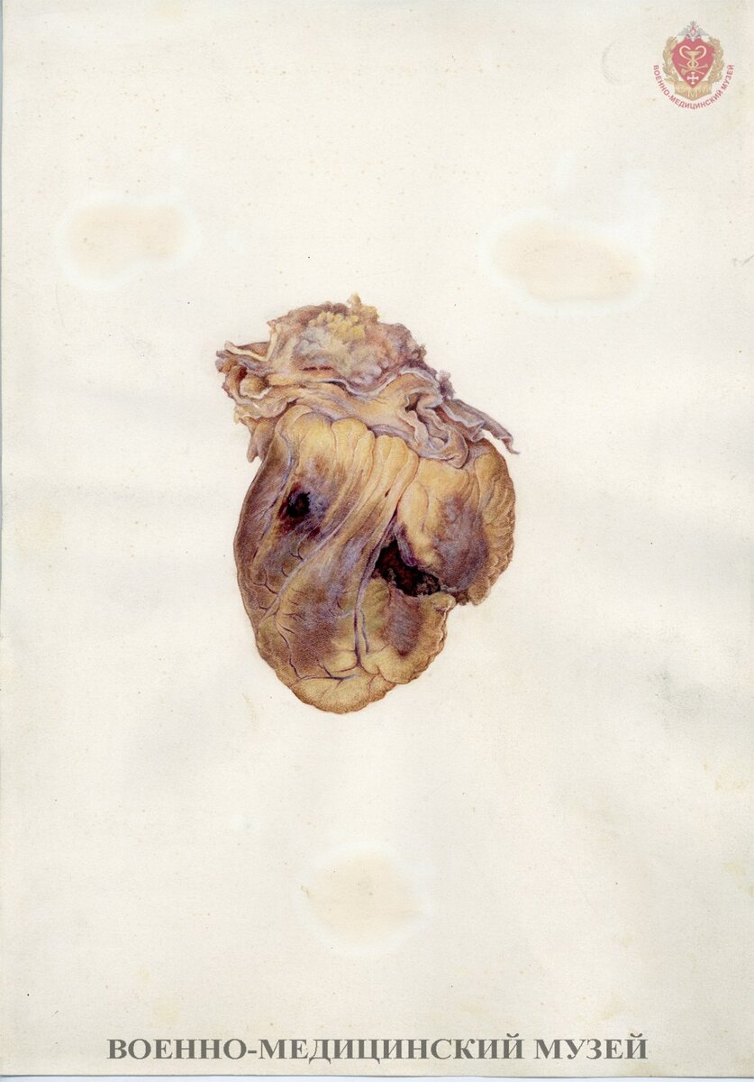 Л. И. Милорадович. Сквозное пулевое ранение сердца