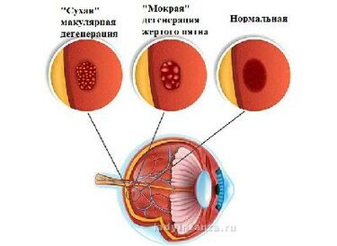 Как говорилось ранее, витамин А выполняет важные функции для нашего зрительного здоровья. Исследования также показывают, что витамина А может предотвратить возрастную дегенерацию желтого пятна. 