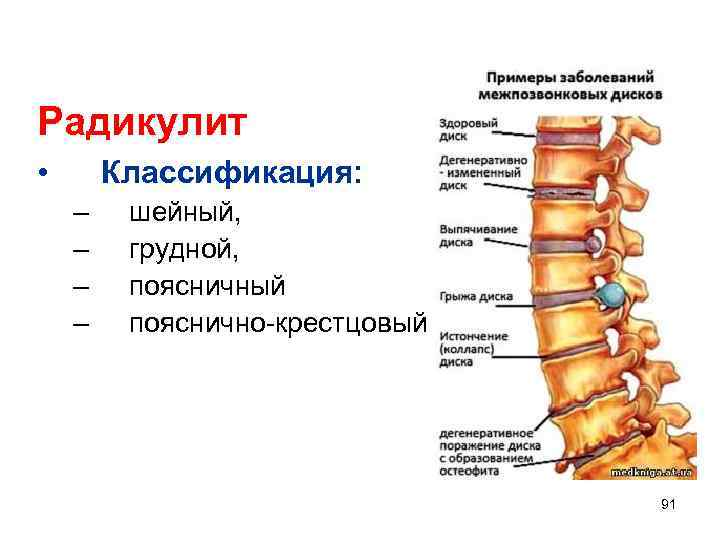 Пояснично-крестцовый радикулит. Радикулит пояснично крестцовый симптомы. Радикулит пояснично кресцовой. Поясни но крестовый радикулит.