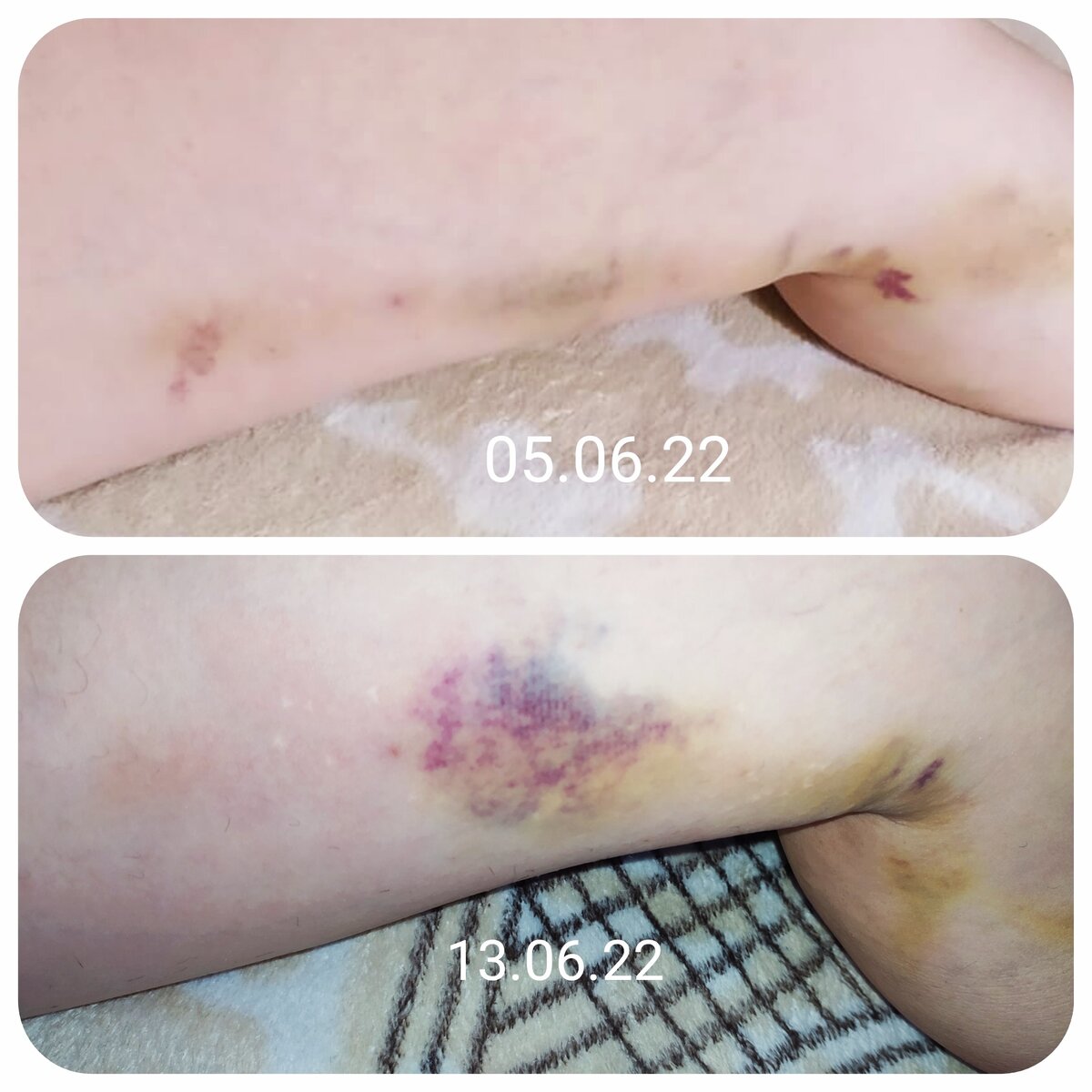 Фото автора, вверху на 4-ый день после операции, внизу - 12-ый день. 