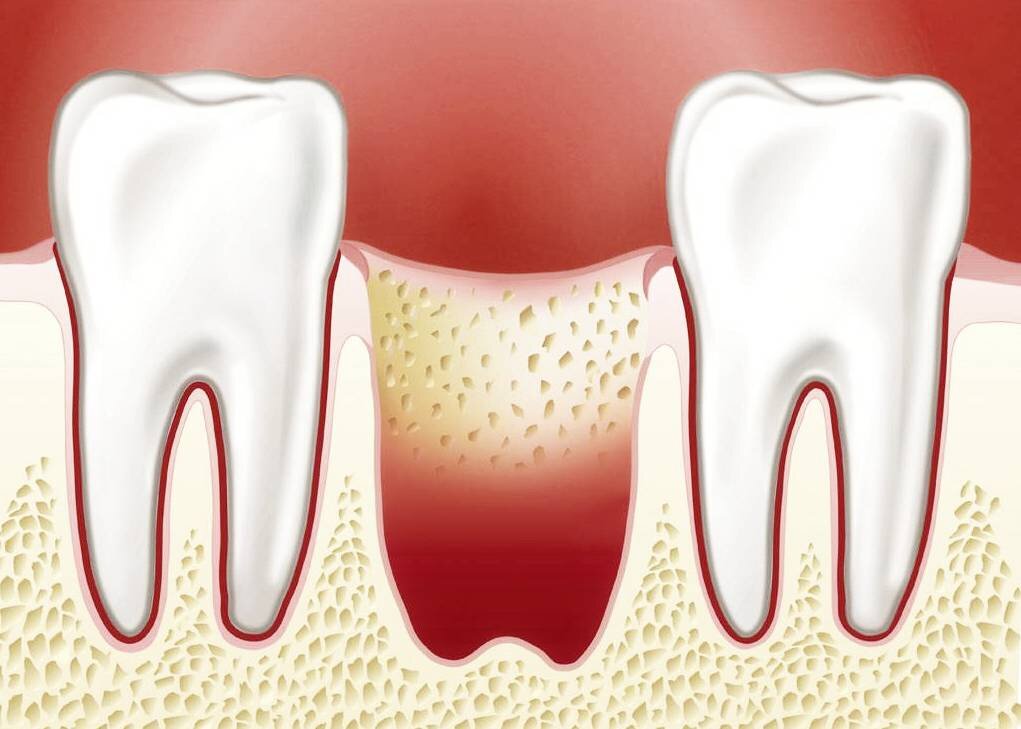 Что «можно» и «нельзя» после удаления зуба