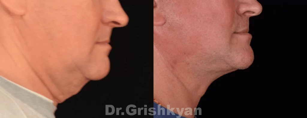 Пластика шеи фото до и после. Фото с сайта Д.Р. Гришкяна. Имеются противопоказания, требуется консультация специалиста