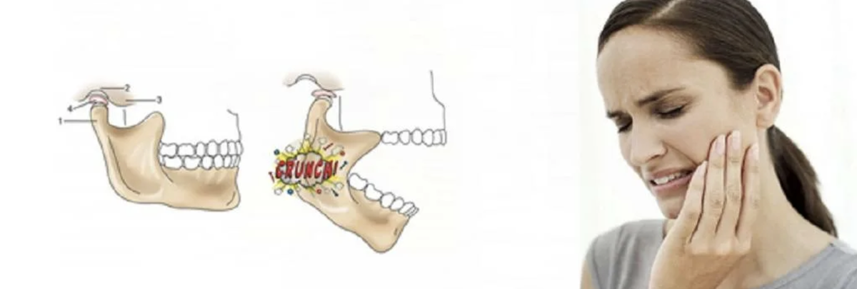 Из за чего может болеть челюсть. Щелкающая челюсть артроз ВНЧС. Дисфункция ВНЧС прикус. Щелчок височно-нижнечелюстного сустава. Нижнечелюстной подвывих челюсти.