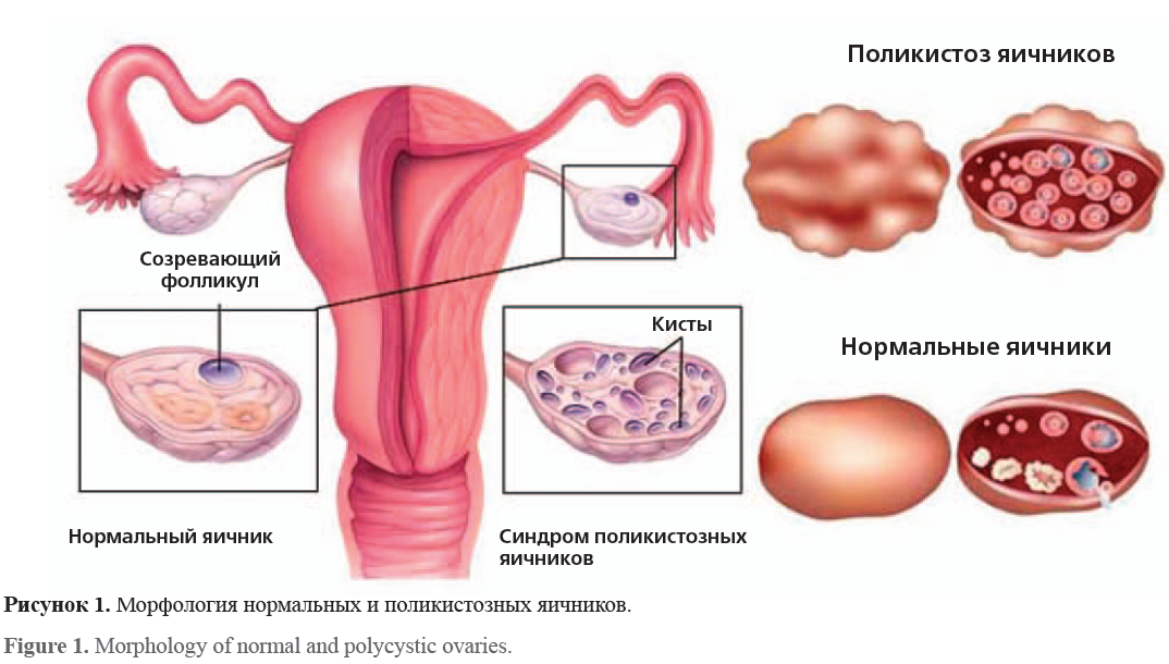 можно ли вылечить поликистоз яичников. синдром поликистоза яичника. клинические симптомы спкя. можно ли вылечить поликистоз яичников. признаки поликистоза яичников.