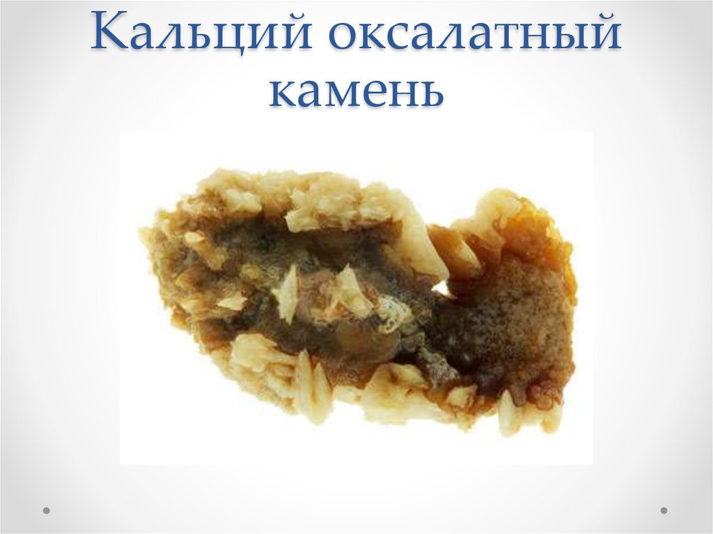 Как выглядят оксалатные камни в почках