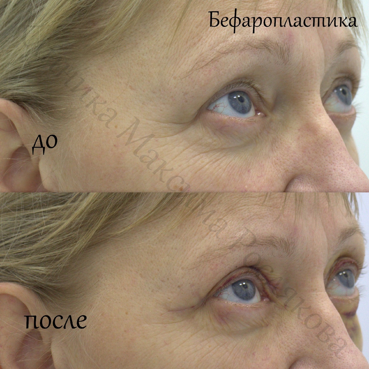 До/После блефаропластики в Клинике Максима Рослякова.                                                              Врач, пластический хирург: М.А. Росляков