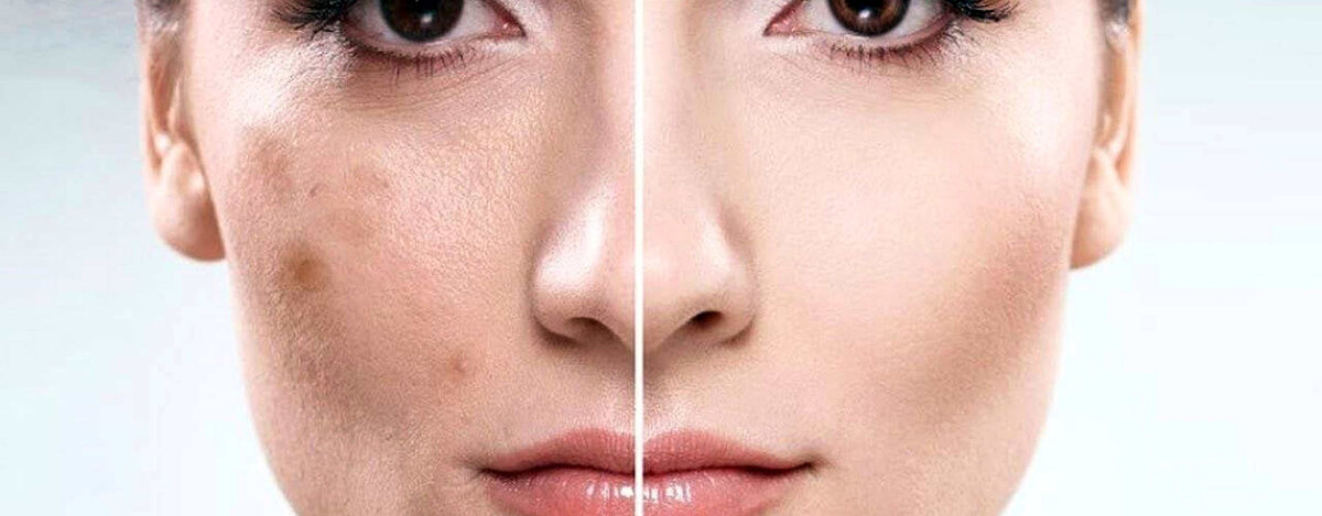 Как убрать пигментные пятна от Солнца?