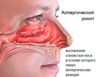 Бронхиальная астма