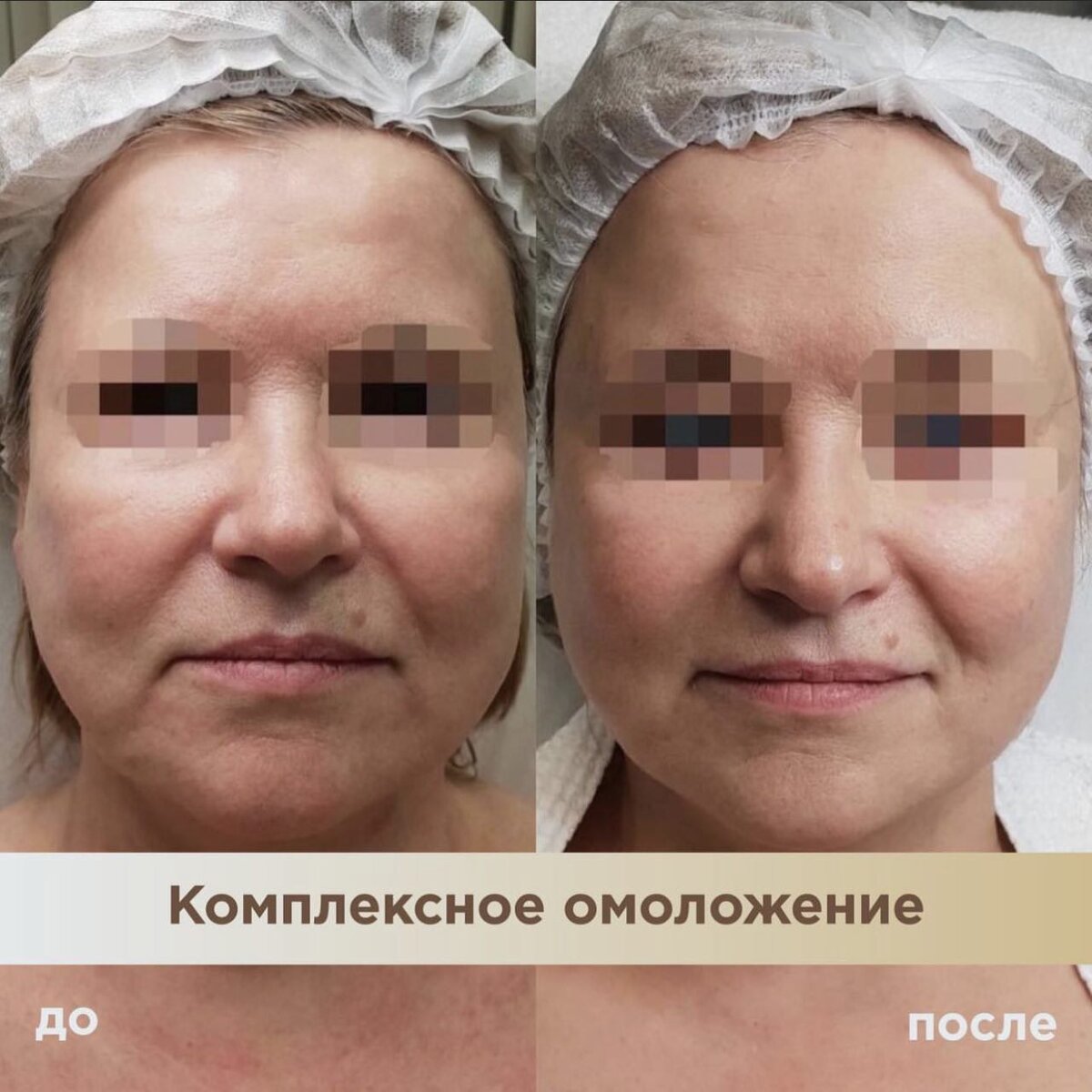 Комплексное омоложение лица. Красивый и естественный результат. | Tori  Clinic | Дзен