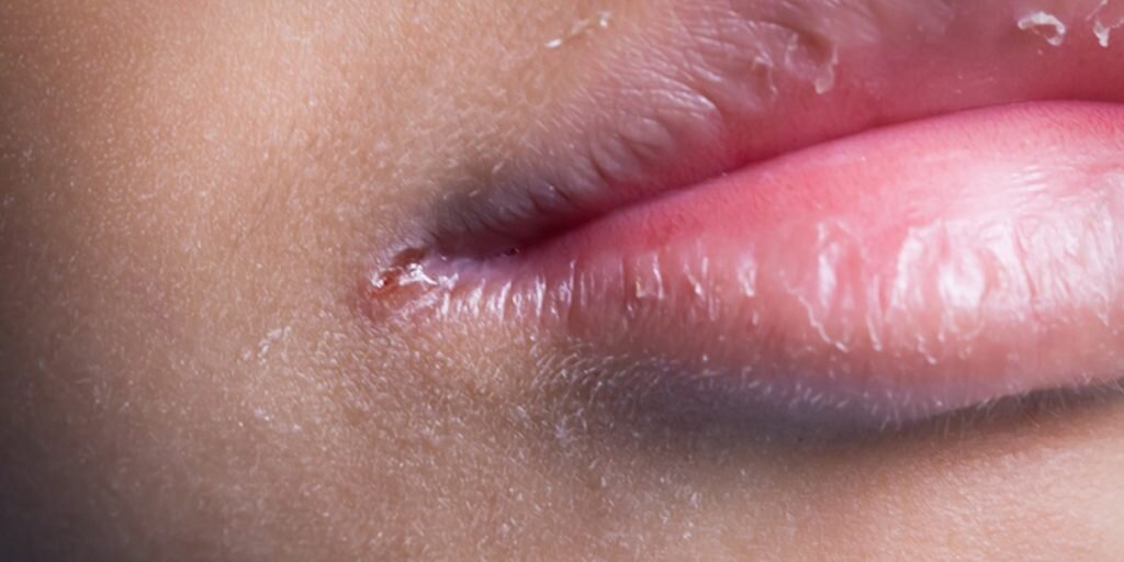 Как лечить заеды на губах Левомеколем?