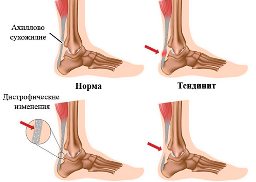 Ахиллесово сухожилие болит при ходьбе лечение картинки