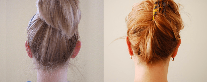 Отопластика "до и после".  Фото с сайта Д.Р. Гришкяна. Имеются противопоказания, требуется консультация специалистов