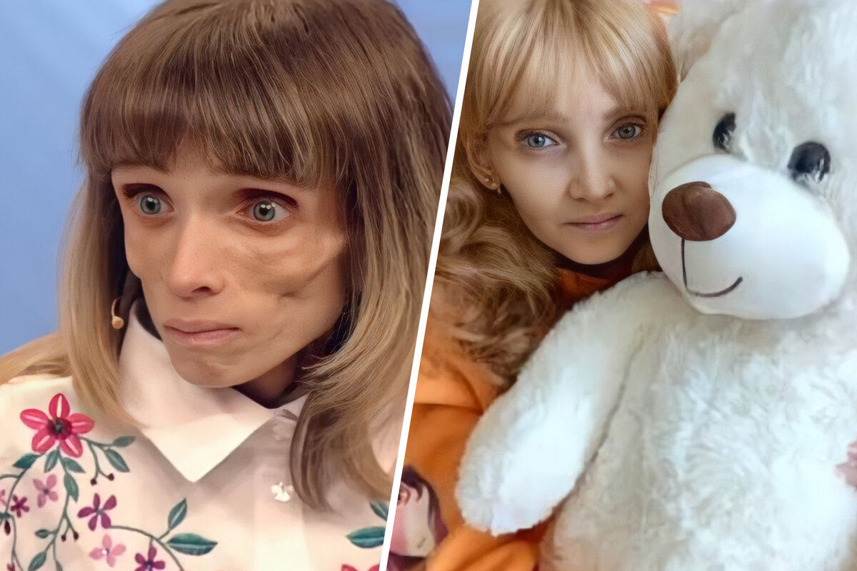 Весила всего 17 кг. Как сейчас живет победившая анарексию Кристина Корягина Звез