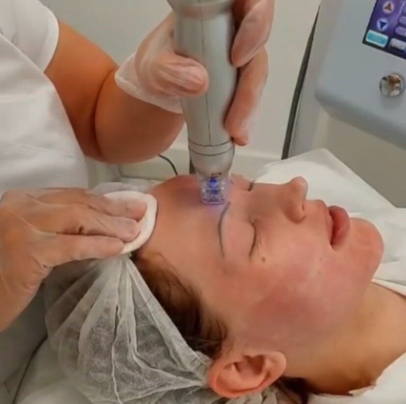 Фракционный RF лифтинг на аппарате Scarlet. Фото предоставлено Д.Р. Гришкяном. Имеются противопоказания, требуется консультация специалиста