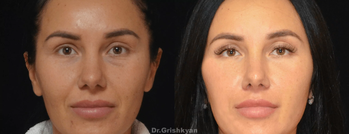 Омоложение лица липофилингом фото до и после. Фото с сайта Д.Р. Гришкяна. Имеются противопоказания, требуется консультация специалиста