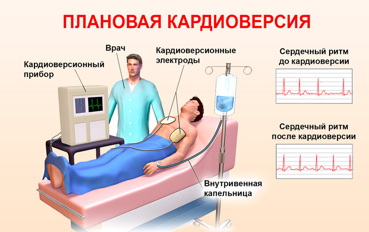 Видите, на нижней ЭКГ мелкие "зубчики" исчезли? Это ушла мерцательная аритмия.