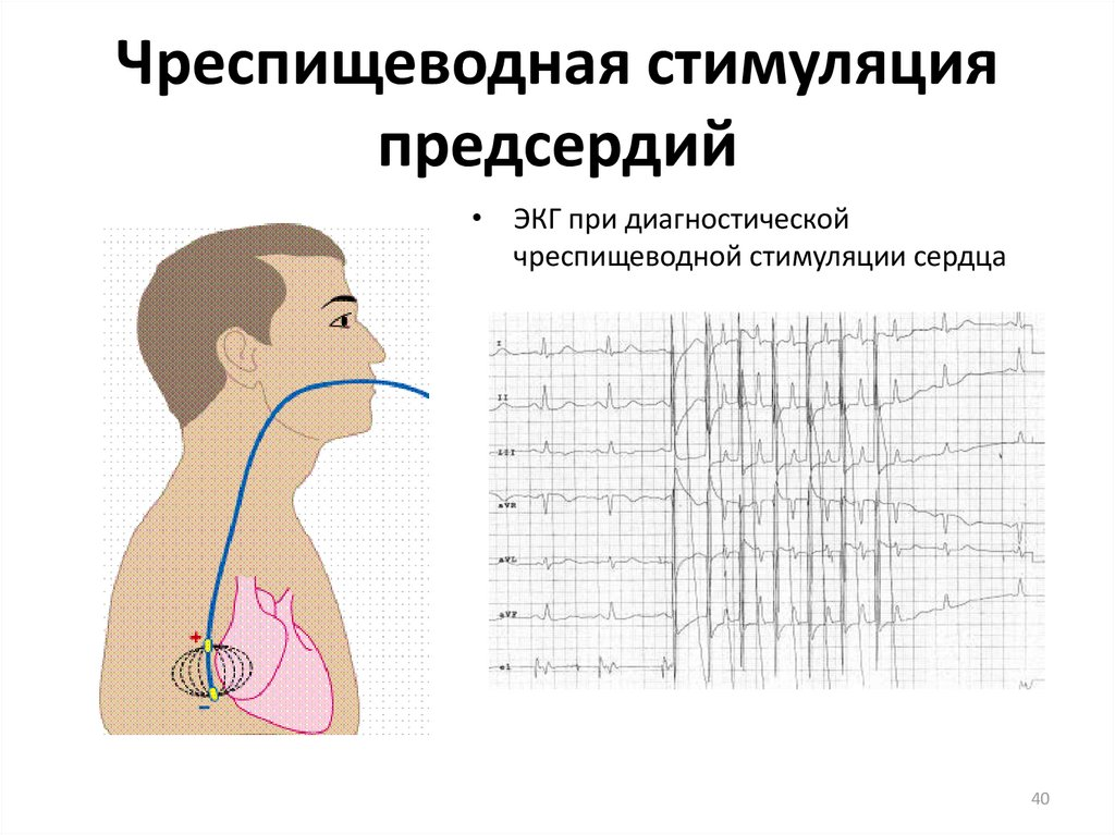 Тахикардия