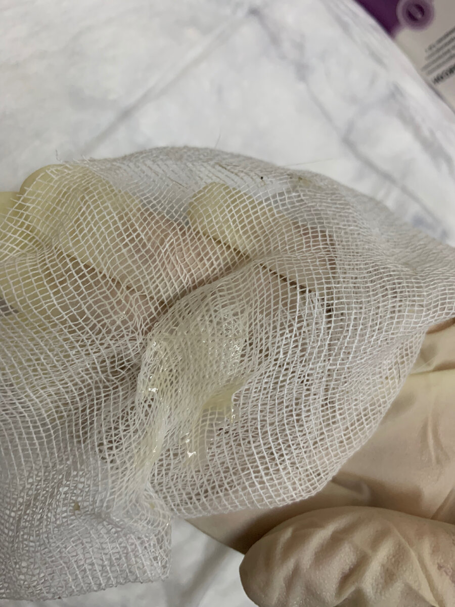 Выделения из петли 