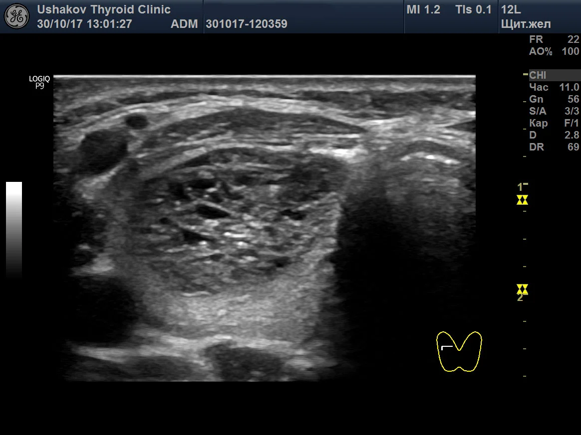 Щитовидная железа узлы в правой доле. Эхограммы узлы щитовидной железы. Губчатый узел щитовидной железы на УЗИ. Щитовидная железа узелок на УЗИ. Узлы щитовидной железы диагноз.