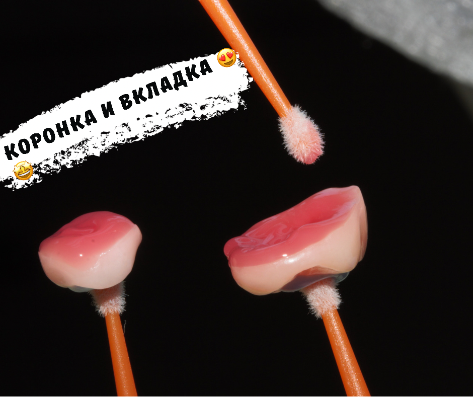 ”КОРОНКА И ВКЛАДКА НА СИЛЬНО РАЗРУШЕННЫЕ  ЗУБЫ 🦷‼️

Вот такой кадр в ленте 😉🙃🙄 вам дорогие клиенты и подписчики . Я обожаю 😍 такие кадры . Планирую в будущем тоже такие необычные кадры . 

Такие конструкции показаны особенно для тех людей , у которых сильно разрушенные 🦷, у которых имеется большие не состоятельные пломбы , не корректно восстановлены стенки ‼️ 

Поэтому не торопитесь лечением и выбору методы лечение , так как все зависит от конструкции😎☝️.
@pd.club @prodoctorov.ru 
——————————————————
Ваш заботливый доктор Dr. Zaripov .
Мой телефон ☎️ 89190128262 или по ☎️ 8(492)277-99-33 в клинике @laviani-clinic
Наш адрес: г. Владимир, ул. Добросельская 176, здание Бэбибум, 2 этаж
#напоминаниедляпациентов
#интервью #отбеливаниезубов #zoom4 
#обменопыта
#амбассадорпд2021
#профилактика 
#стоматологВладимир #дрзарипов #дрзарипов_отбеливание #отбеливание #philipszoom #консультациястоматолога #знакомство 
#коффердам #изоляция