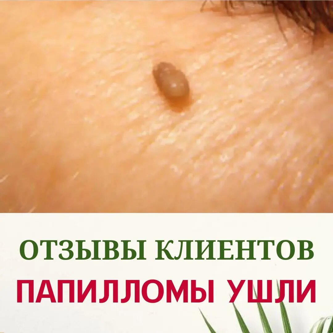 Папилломы ушли