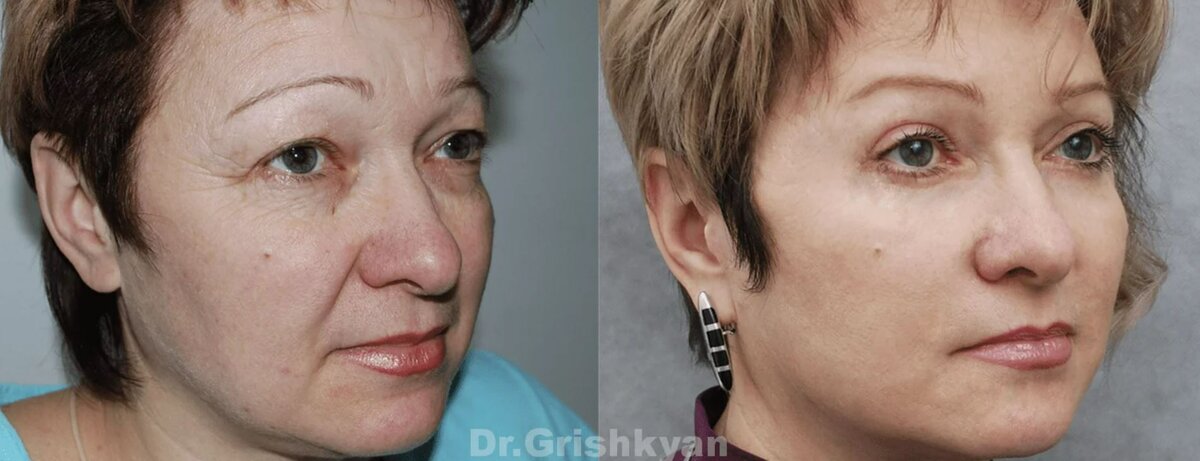 Круговая подтяжка лица фото до и после. Фото с сайта Д.Р. Гришкяна. Имеются противопоказания, требуется консультация специалиста