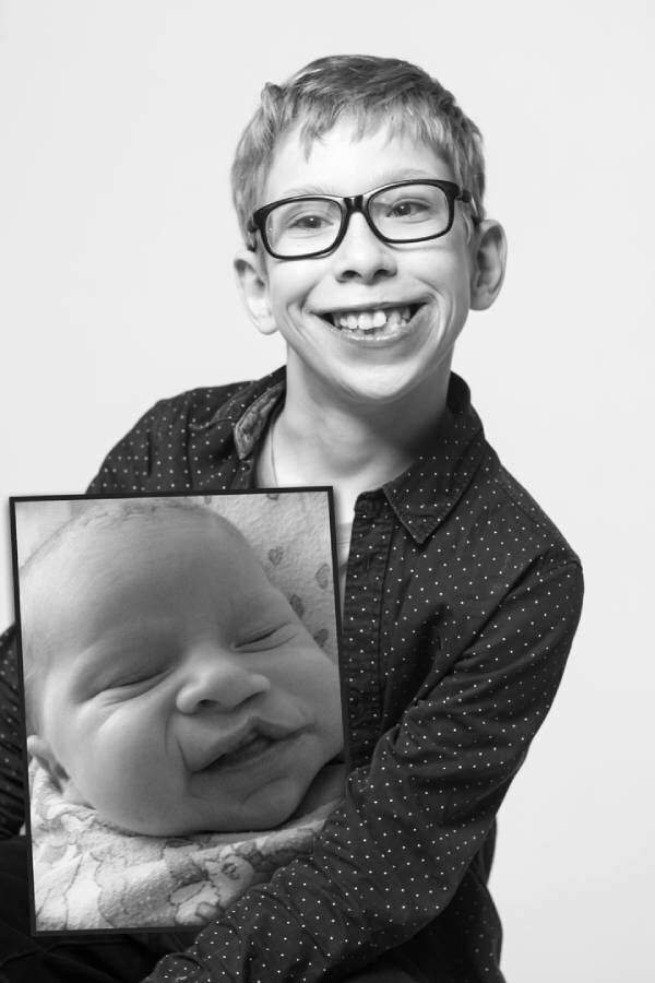 «Заячья губа» и «волчья пасть». Мифы о врожденной расщелине губы и неба ...