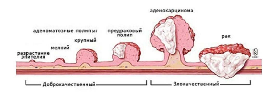 Полипы желудка