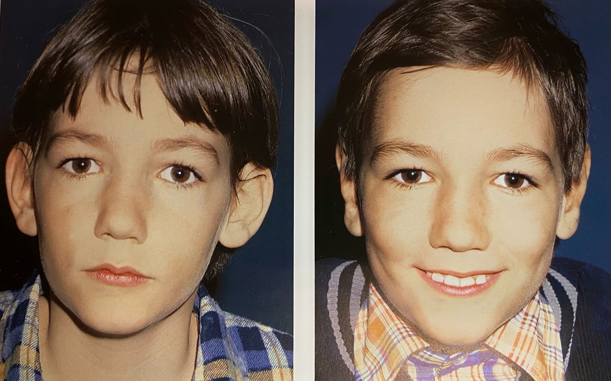 Результат до/после коррекции ушной раковины.