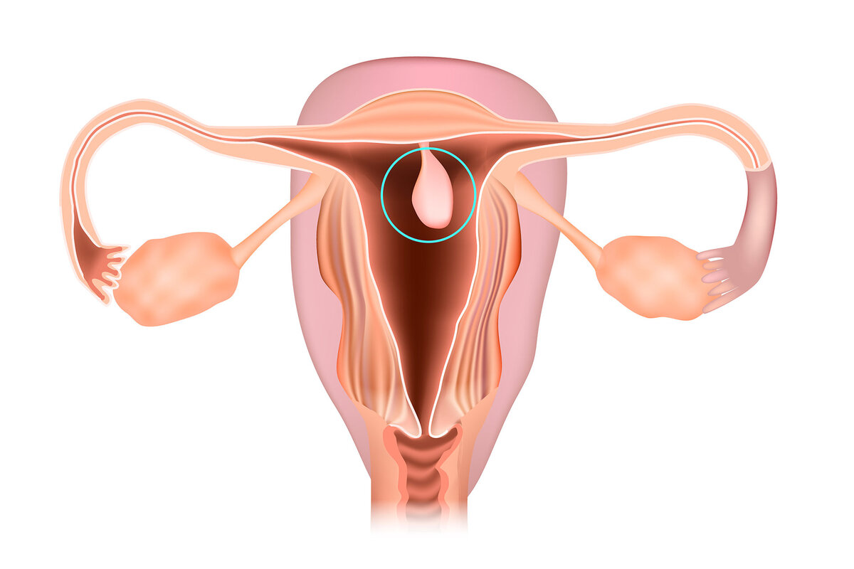 Вариант расположения полипа в матке
