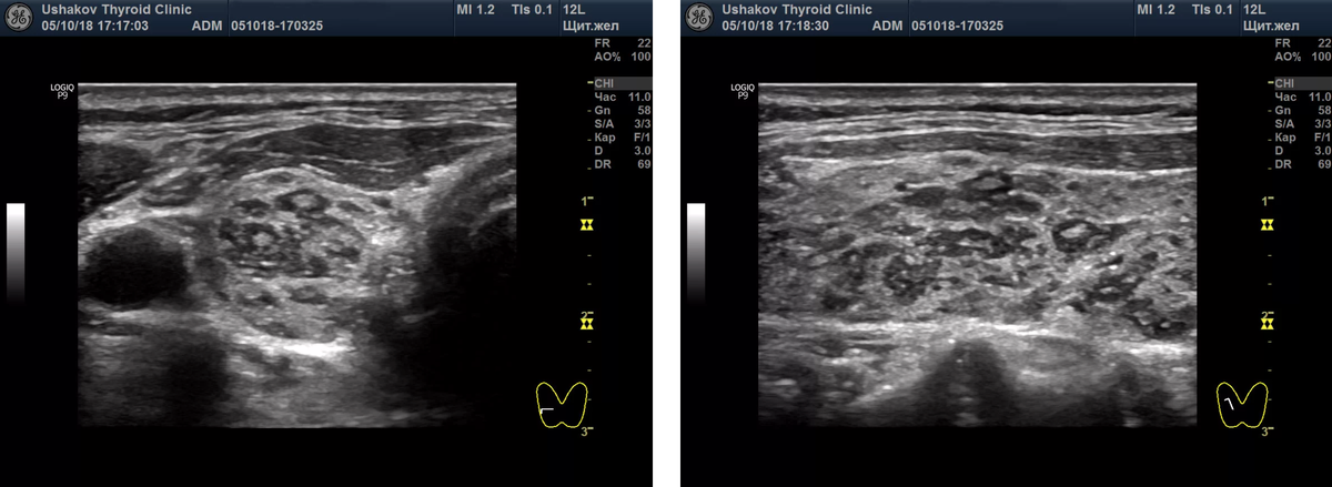 Гипоэхогенная щитовидная железа