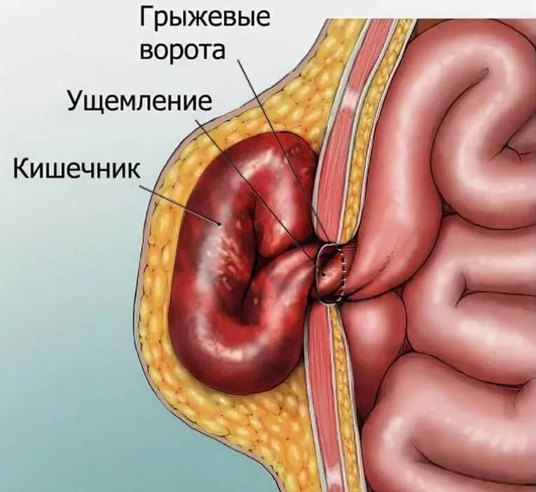 Грыжа ли. Ущемленная пупочная грыжа. Ущемленная вентральная грыжа. Послеоперационного вентральная грыжа брюшная полость. Пупочная грыжа ущемленная сальника