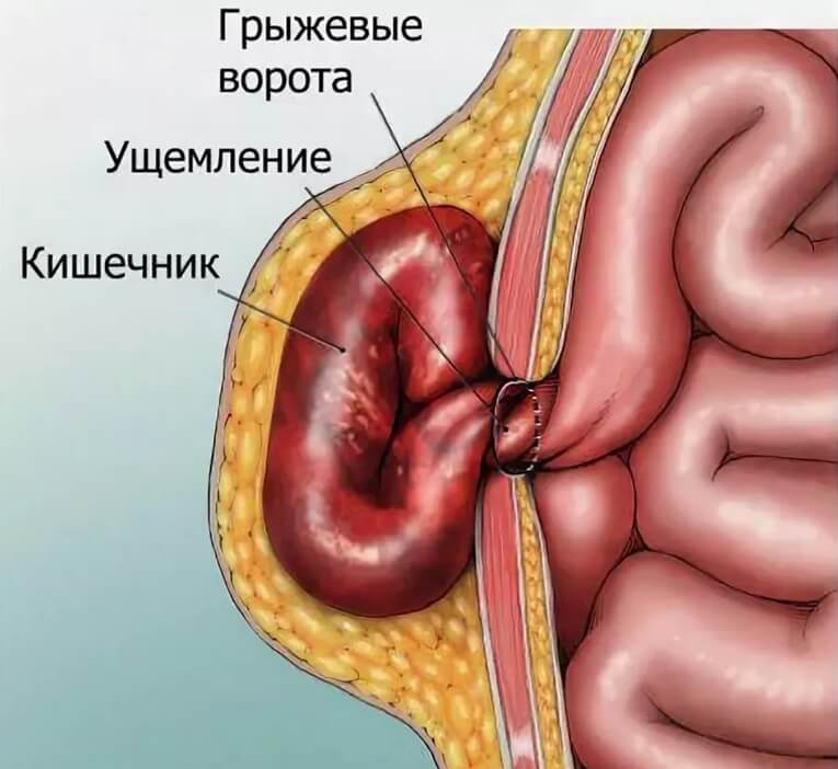 Грыжа передней стенки. Ущемленная пупочная грыжа. Ущемленная вентральная грыжа. Послеоперационного вентральная грыжа брюшная полость. Пупочная грыжа ущемленная сальника.