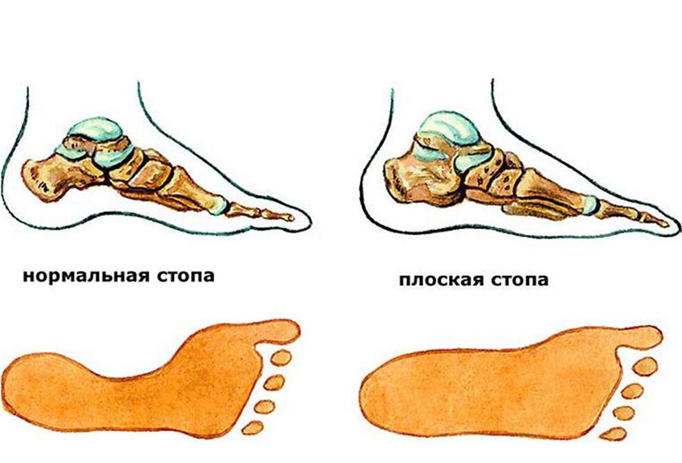 Что такое свод стопы и что с ним делать в балете | Всем балет! | Дзен