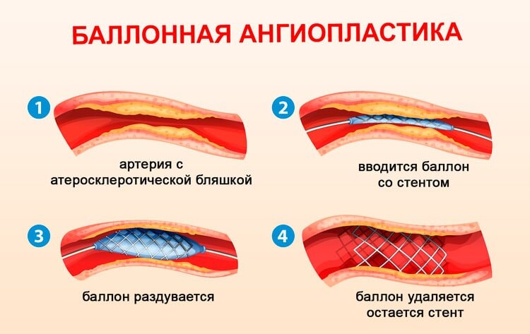 Баллонная ангиопластика нижних