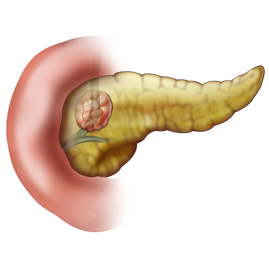 Стадии рака поджелудочной железы. Новообразование поджелудочной железы. Поджелудочной железы (опухоли и панкреатит);. Злокачественная опухоль поджелудочной железы. Тумор поджелудочной железы.