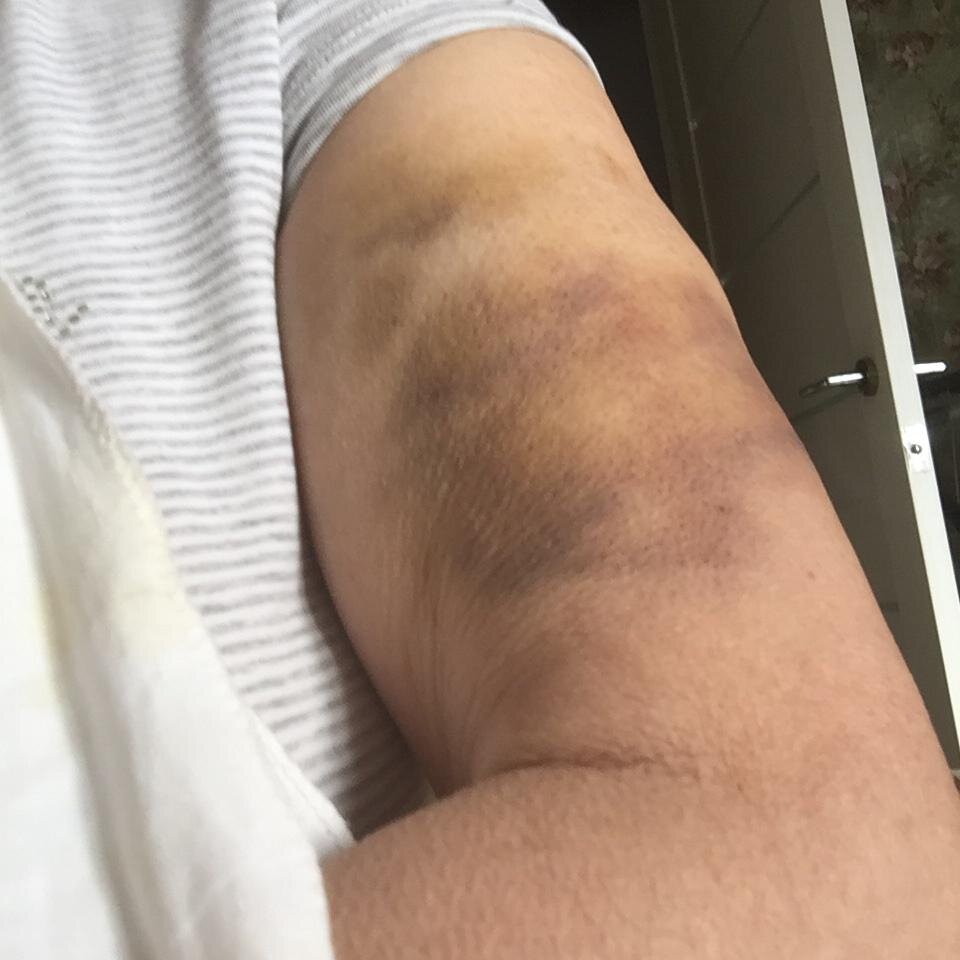 Так выглядела моя несчастная больная рука, это уже когда стало полегче.  Вначале было не до фотосессий. 