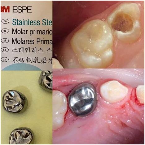 Зачем ставить коронки на молочные зубы? 