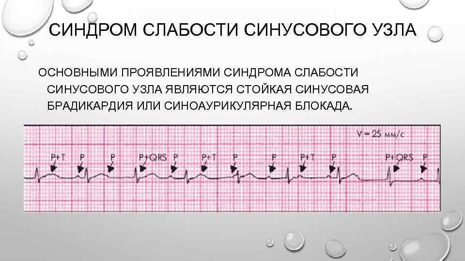Слабость синусового узла карта вызова