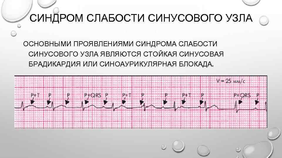 Синдром слабости синусового узла карта вызова смп