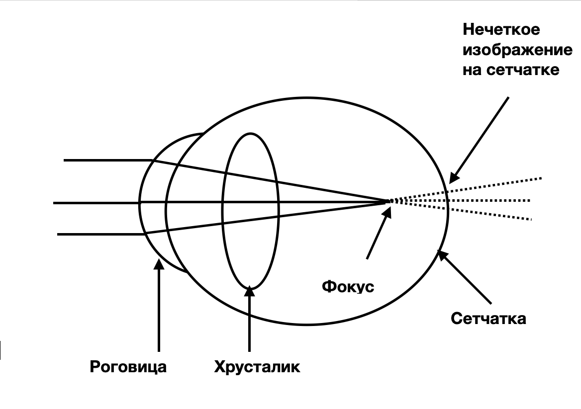 Миопия (близорукость): ее причины и советы по ее укрощению | Глаза. Зрение.  Оптометрия. | Дзен