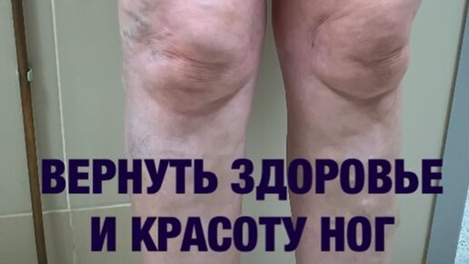 Сергей Якушкин: флеболог | Как без операции вылечить варикозную болезнь ...