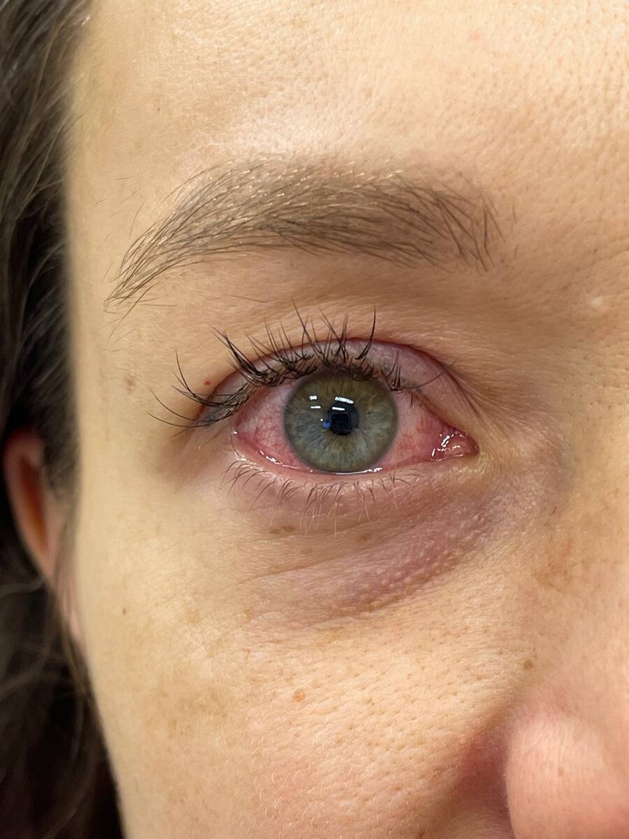 Классический вид глаза с вирусным конъюнктивитом - красный, слезящийся (почти водянистый) и при этом с сильной реакцией на свет.