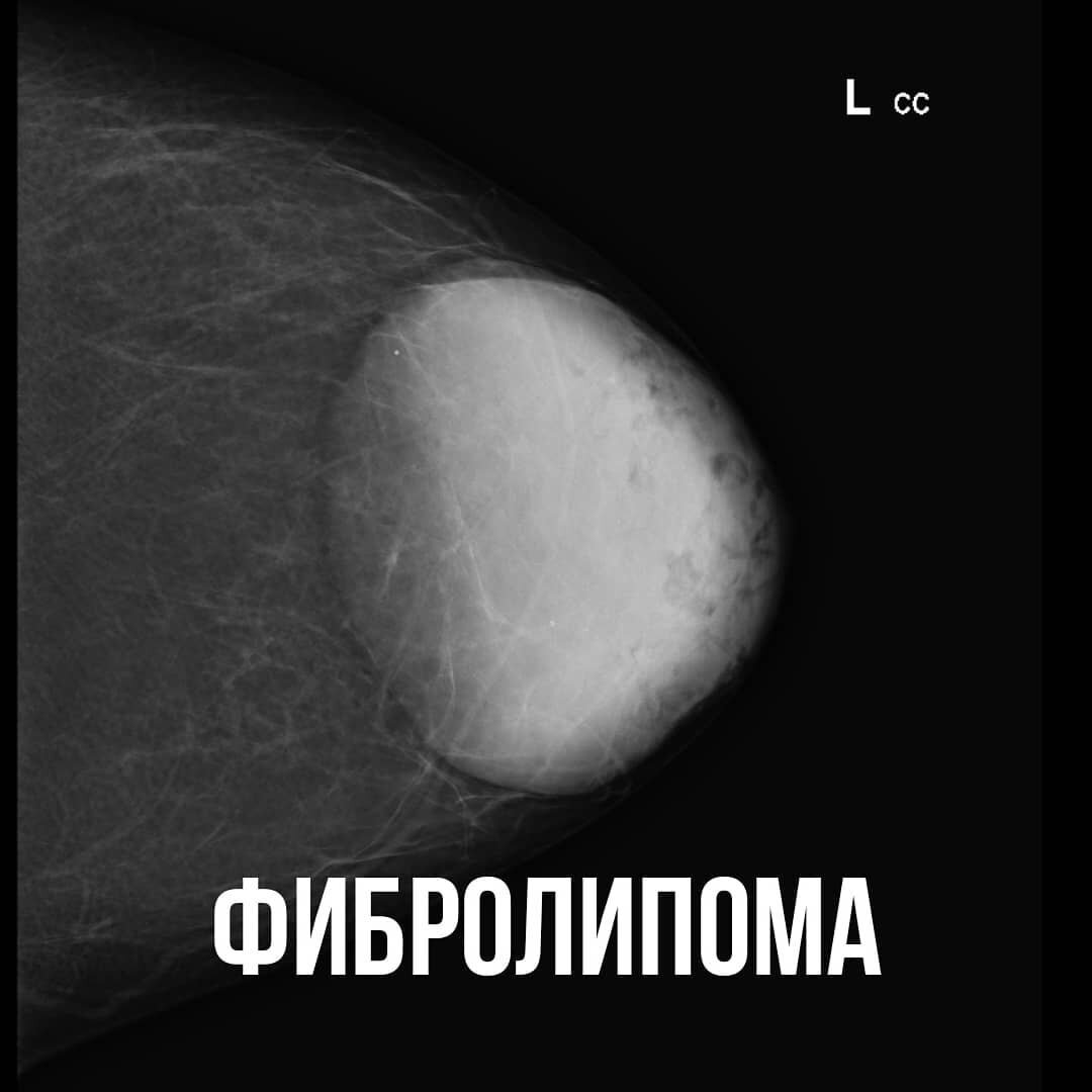ФИБРОЛИПОМА МОЛОЧНОЙ ЖЕЛЕЗЫ | Маммология и хирургия РНЦРР | Дзен